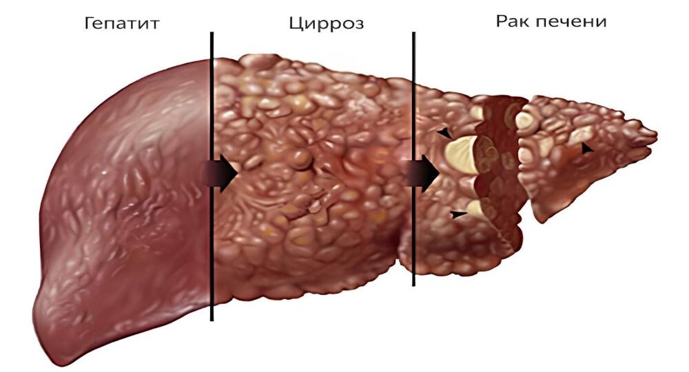 Заболевания печени: от гепатита до цирроза